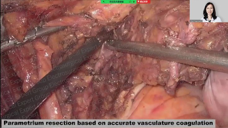 Webinar recording |  Laparoscopic surgery of gynecological cancer